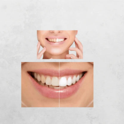 Blanqueador Dental™ Teeth Whitening